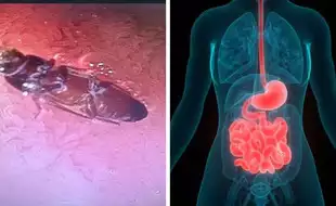 Delhi Doctors Remove 3cm-long Live Cockroach From A Young Man's Intestine