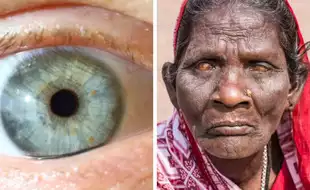 WHO Declares India As Trachoma Free; Know What Causes This Preventable Blindness