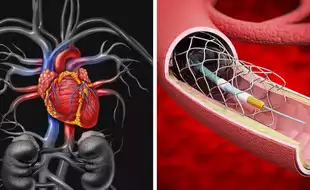 US FDA Approves New Heart Stents For Infants and Children Born With Congenital Heart Disease To Avoid Series Of Surgeries